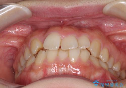 変則的な抜歯矯正 八重歯を抜いてしまった人のワイヤー矯正の治療前