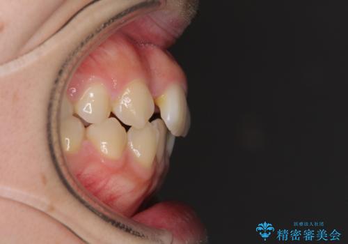 変則的な抜歯矯正 八重歯を抜いてしまった人のワイヤー矯正の治療前