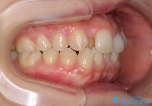 変則的な抜歯矯正 八重歯を抜いてしまった人のワイヤー矯正の治療前