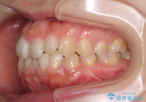 変則的な抜歯矯正 八重歯を抜いてしまった人のワイヤー矯正の治療前