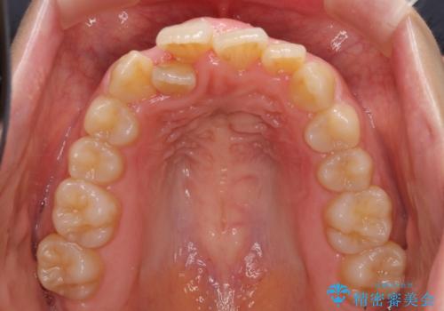 変則的な抜歯矯正 八重歯を抜いてしまった人のワイヤー矯正の治療前