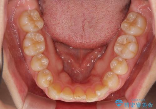 変則的な抜歯矯正 八重歯を抜いてしまった人のワイヤー矯正の治療前