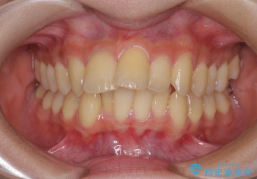 出っ歯を治したい ワイヤー装置による抜歯矯正の症例 治療前