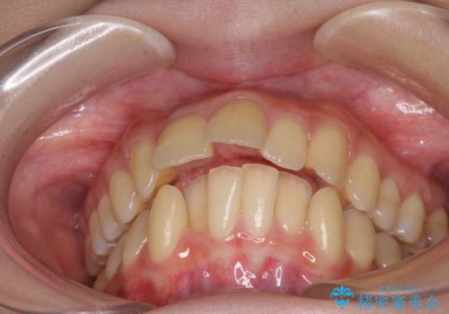 出っ歯を治したい ワイヤー装置による抜歯矯正の治療前