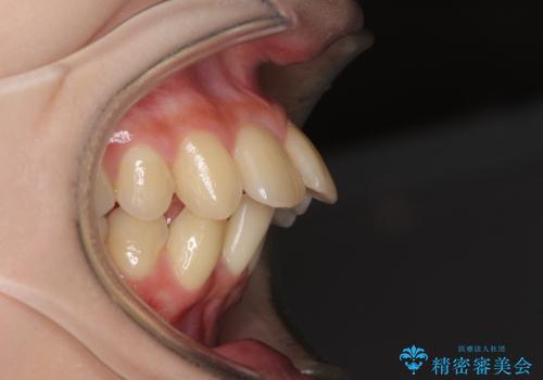 出っ歯を治したい ワイヤー装置による抜歯矯正の治療前