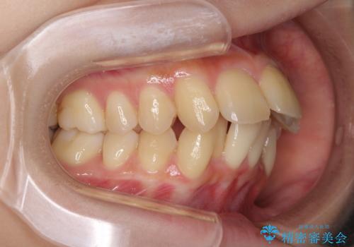 出っ歯を治したい　ワイヤー装置による抜歯矯正の治療前