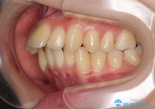 出っ歯を治したい　ワイヤー装置による抜歯矯正の治療前