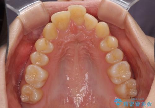 出っ歯を治したい ワイヤー装置による抜歯矯正の治療前