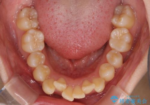 出っ歯を治したい ワイヤー装置による抜歯矯正の治療前