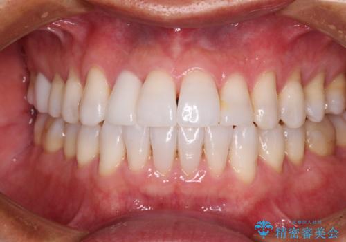 治療途中の前歯を治したい インビザライン矯正とオールセラミッククラウンの症例 治療後