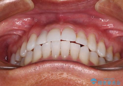 治療途中の前歯を治したい インビザライン矯正とオールセラミッククラウンの治療後