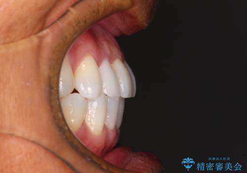 治療途中の前歯を治したい インビザライン矯正とオールセラミッククラウンの治療後