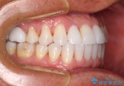 治療途中の前歯を治したい インビザライン矯正とオールセラミッククラウンの治療後