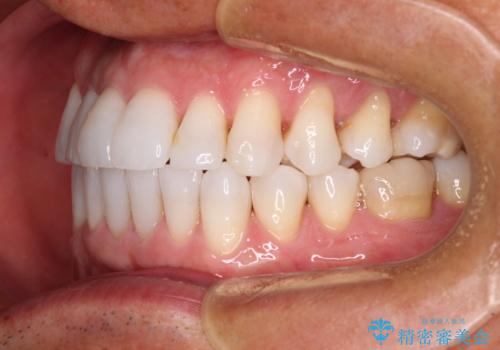 治療途中の前歯を治したい インビザライン矯正とオールセラミッククラウンの治療後