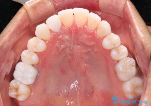 治療途中の前歯を治したい インビザライン矯正とオールセラミッククラウンの治療後