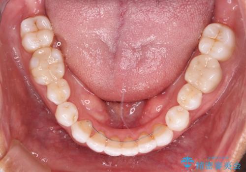 治療途中の前歯を治したい インビザライン矯正とオールセラミッククラウンの治療後