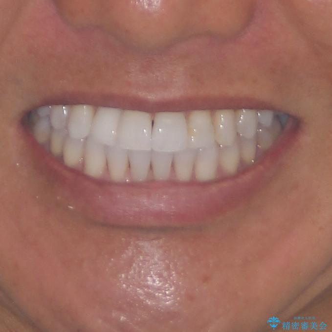 治療途中の前歯を治したい インビザライン矯正とオールセラミッククラウンの治療後(顔貌)