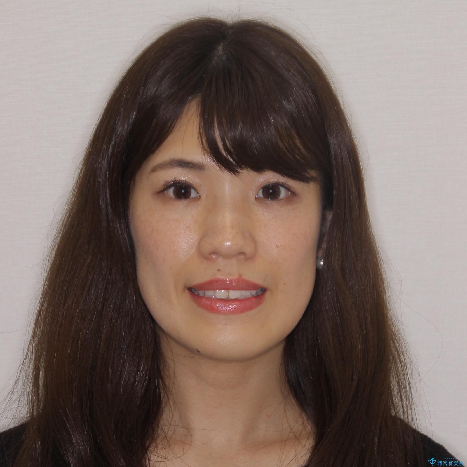 【モニター】前歯のデコボコをインビザラインできれいに整えるの治療前(顔貌)