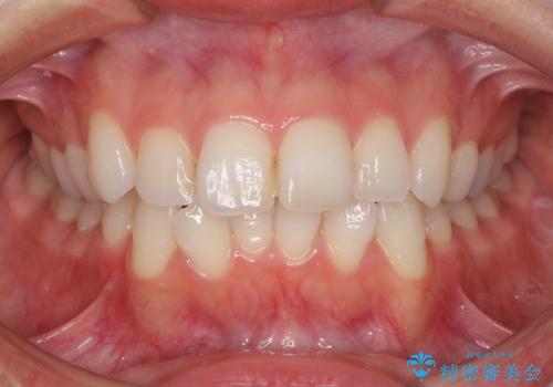 【モニター】前歯のデコボコをインビザラインできれいに整えるの症例 治療前