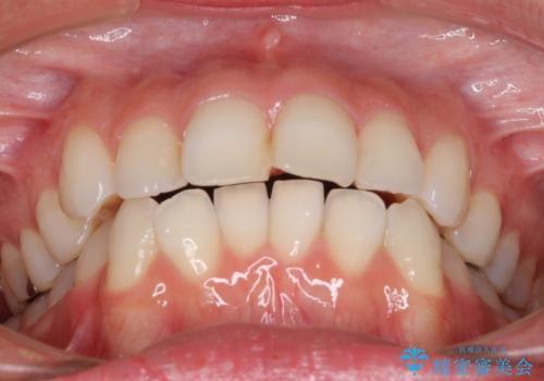 【モニター】前歯のデコボコをインビザラインできれいに整えるの治療前