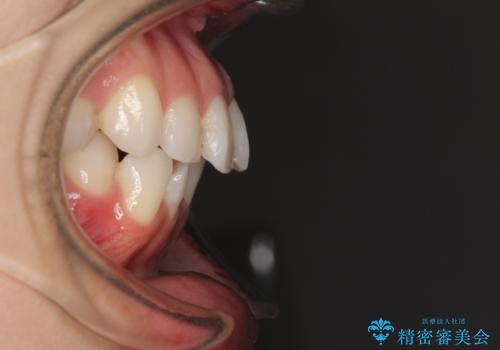 【モニター】前歯のデコボコをインビザラインできれいに整えるの治療前