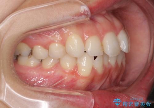 【モニター】前歯のデコボコをインビザラインできれいに整えるの治療前