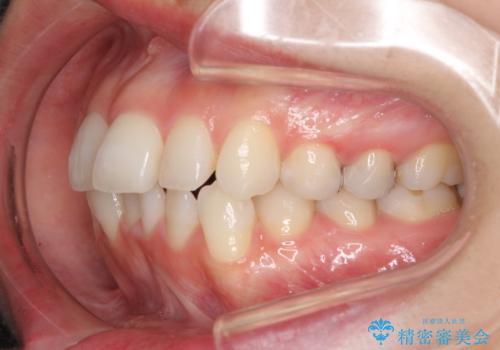 【モニター】前歯のデコボコをインビザラインできれいに整えるの治療前
