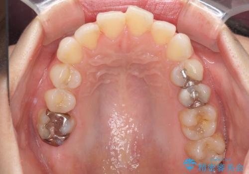 【モニター】前歯のデコボコをインビザラインできれいに整えるの治療前