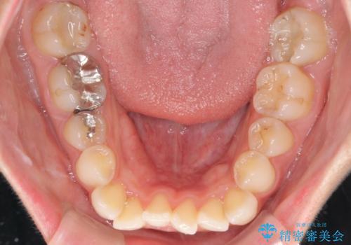 【モニター】前歯のデコボコをインビザラインできれいに整えるの治療前