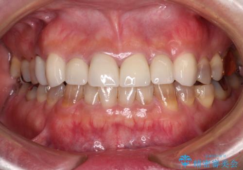 テトラサイクリン歯をオールセラミッククラウンで審美的にの治療後