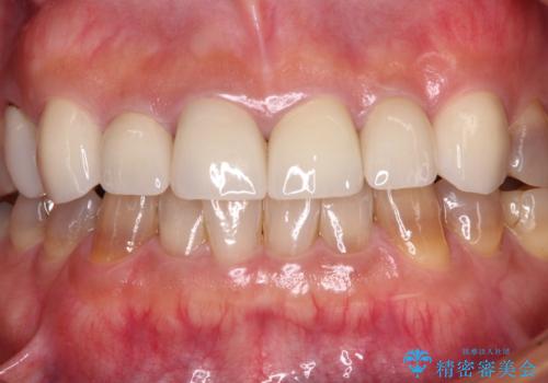 テトラサイクリン歯をオールセラミッククラウンで審美的にの治療後