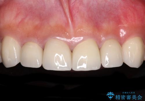 テトラサイクリン歯をオールセラミッククラウンで審美的にの症例 治療後