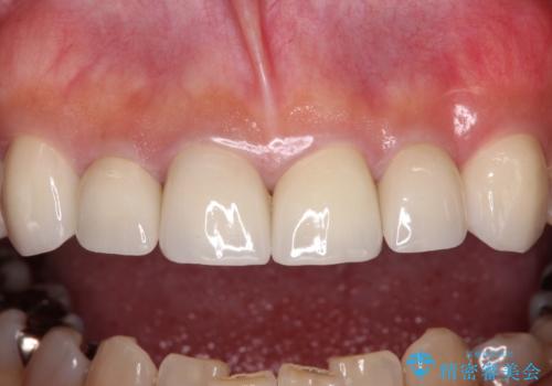 テトラサイクリン歯をオールセラミッククラウンで審美的にの治療後