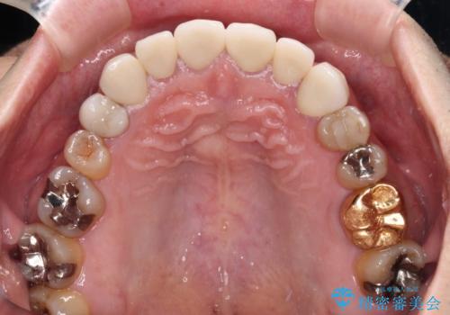 テトラサイクリン歯をオールセラミッククラウンで審美的にの治療後