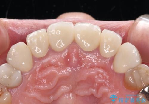 テトラサイクリン歯をオールセラミッククラウンで審美的にの治療後