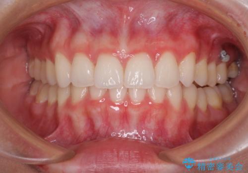 飛び出した前歯と黄ばんだ歯 ホワイトニングしながらマウスピース矯正の治療中