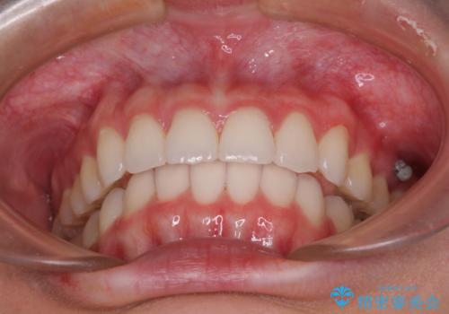 飛び出した前歯と黄ばんだ歯 ホワイトニングしながらマウスピース矯正の治療中