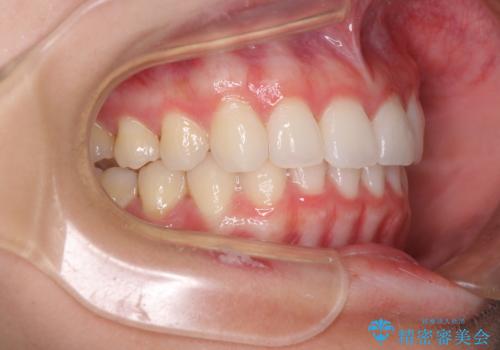 飛び出した前歯と黄ばんだ歯 ホワイトニングしながらマウスピース矯正の治療中