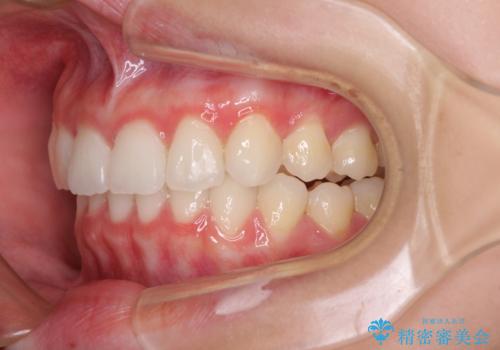 飛び出した前歯と黄ばんだ歯 ホワイトニングしながらマウスピース矯正の治療中