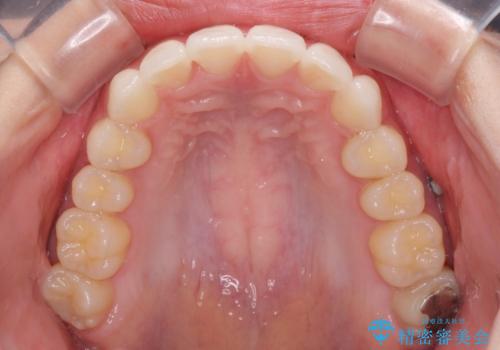 飛び出した前歯と黄ばんだ歯 ホワイトニングしながらマウスピース矯正の治療中