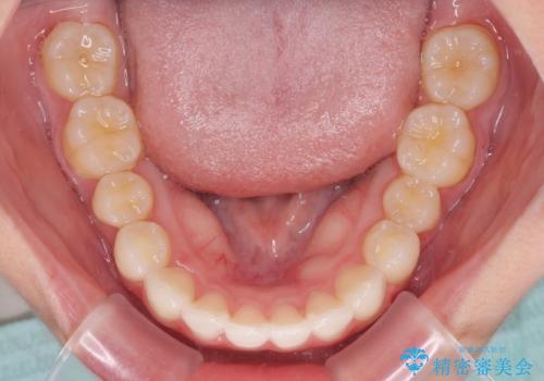 飛び出した前歯と黄ばんだ歯 ホワイトニングしながらマウスピース矯正の治療中