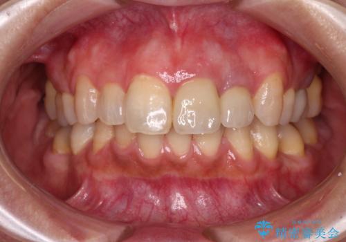 横から見た時の歯の色が違いすぎる 前歯のオールセラミッククラウンの治療後