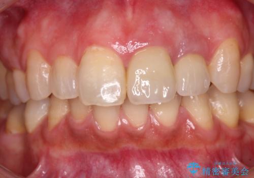 横から見た時の歯の色が違いすぎる　前歯のオールセラミッククラウンの治療後