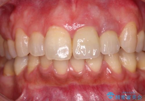 横から見た時の歯の色が違いすぎる 前歯のオールセラミッククラウンの治療後