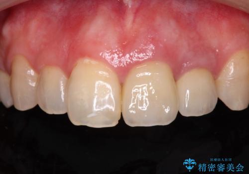 横から見た時の歯の色が違いすぎる　前歯のオールセラミッククラウンの症例 治療後