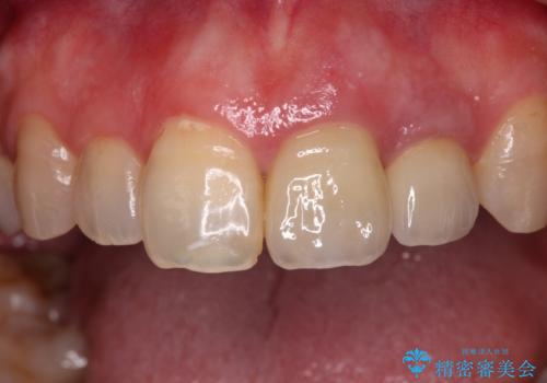 横から見た時の歯の色が違いすぎる 前歯のオールセラミッククラウンの治療後