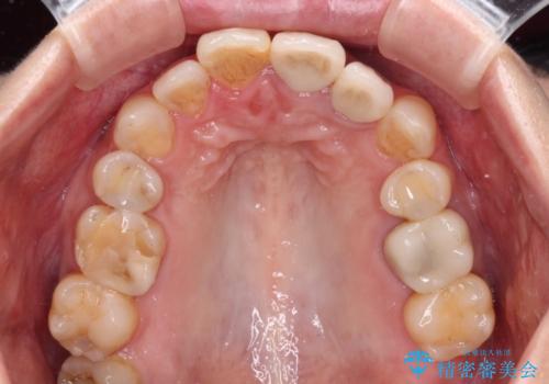 横から見た時の歯の色が違いすぎる 前歯のオールセラミッククラウンの治療後