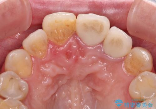 横から見た時の歯の色が違いすぎる 前歯のオールセラミッククラウンの治療後