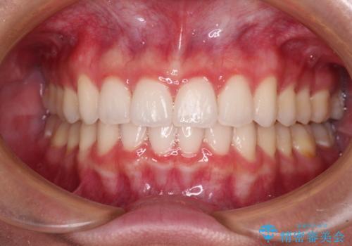 飛び出した前歯と黄ばんだ歯 ホワイトニングしながらマウスピース矯正の治療後
