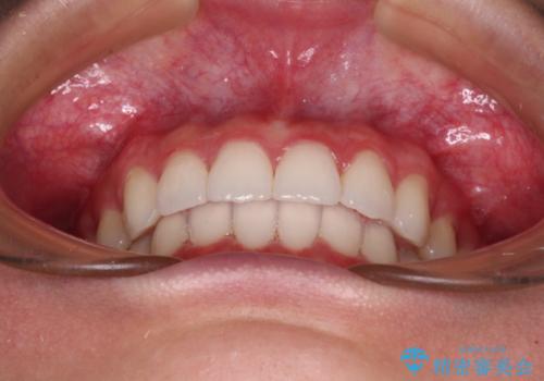 飛び出した前歯と黄ばんだ歯 ホワイトニングしながらマウスピース矯正の治療後